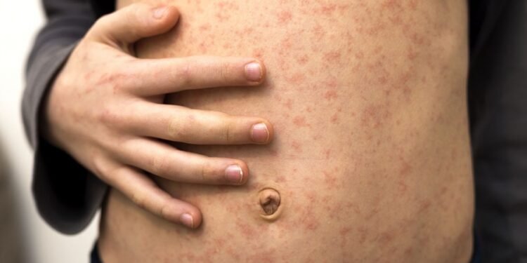 Confirmaron en CABA un caso de sarampión importado desde Medio Oriente